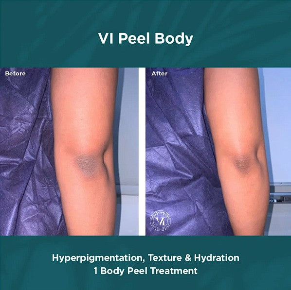 B2GOF VI Peel Body