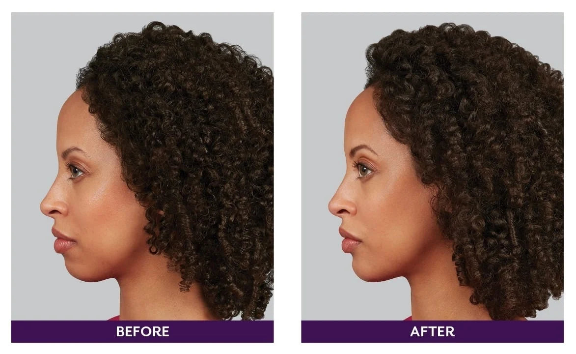 B2GOF DERMAL FILLER