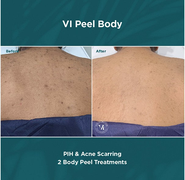 B2GOF VI Peel Body
